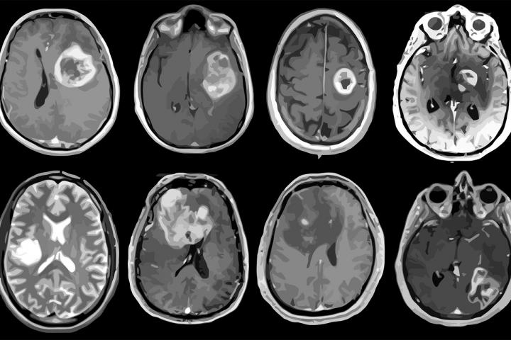 Magnetic resonance imaging of eight patients with glioblastoma.