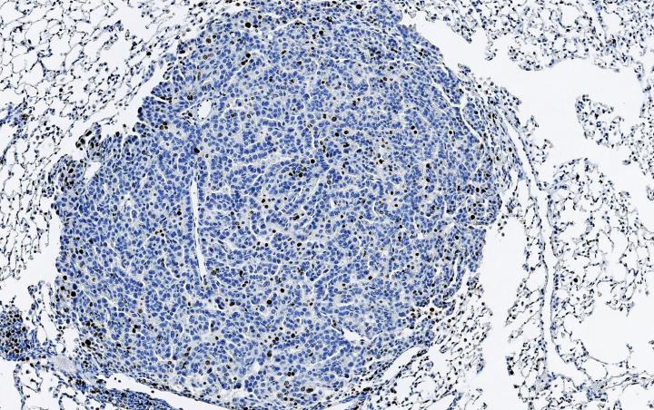 Lung tumor stained for proliferating cells