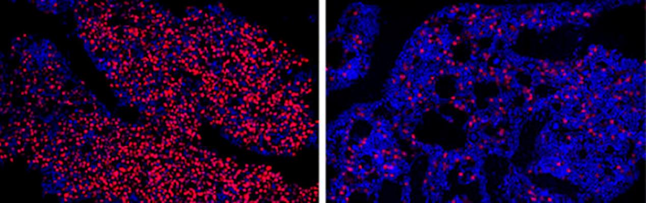 myeloma-bearing mouse treated with the antisense oligonucleotide ION251
