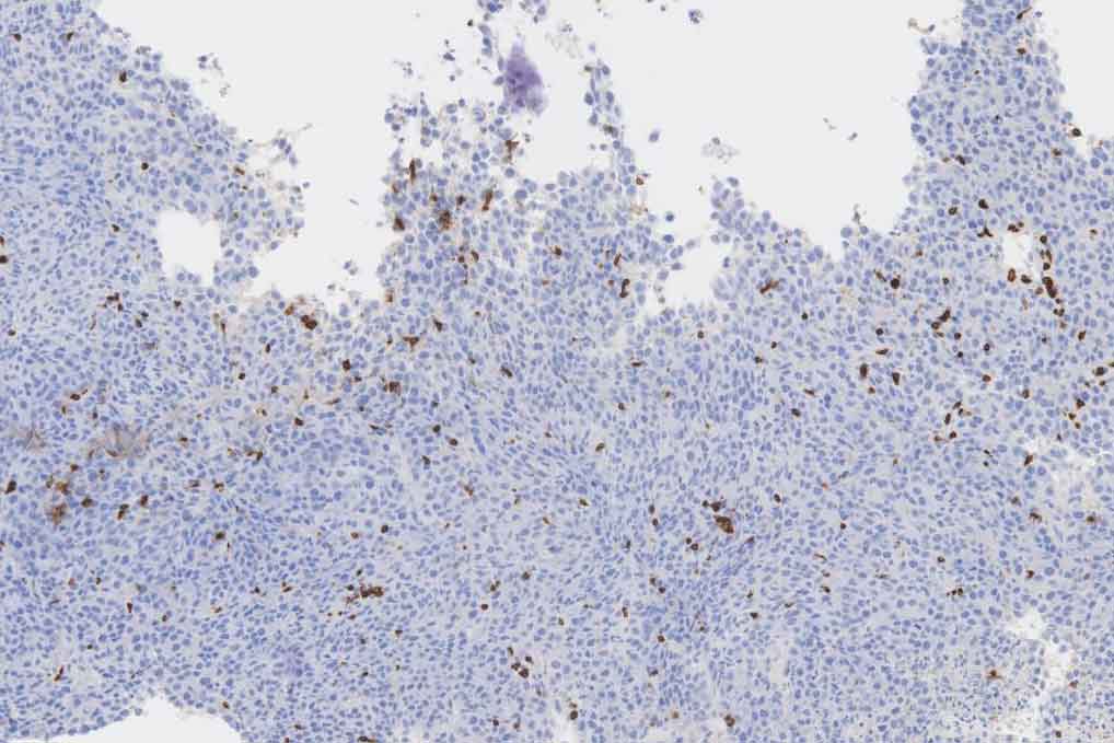 Immunohistochemistry staining of T-cell populations in colorectal tumor tissue